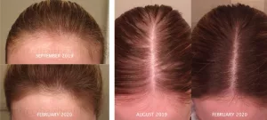 Nutrafol Bad Reviews: Real User Gripes