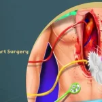 Open Heart Surgery Cost Guide 2023