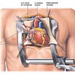 Guide to Open Heart Surgery Recovery Time