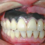 Oral Cancer Black Spot on Gums Photos: What That Dark Dot Could Mean