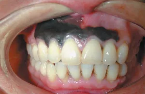 Oral Cancer Black Spot on Gums Photos: What That Dark Dot Could Mean