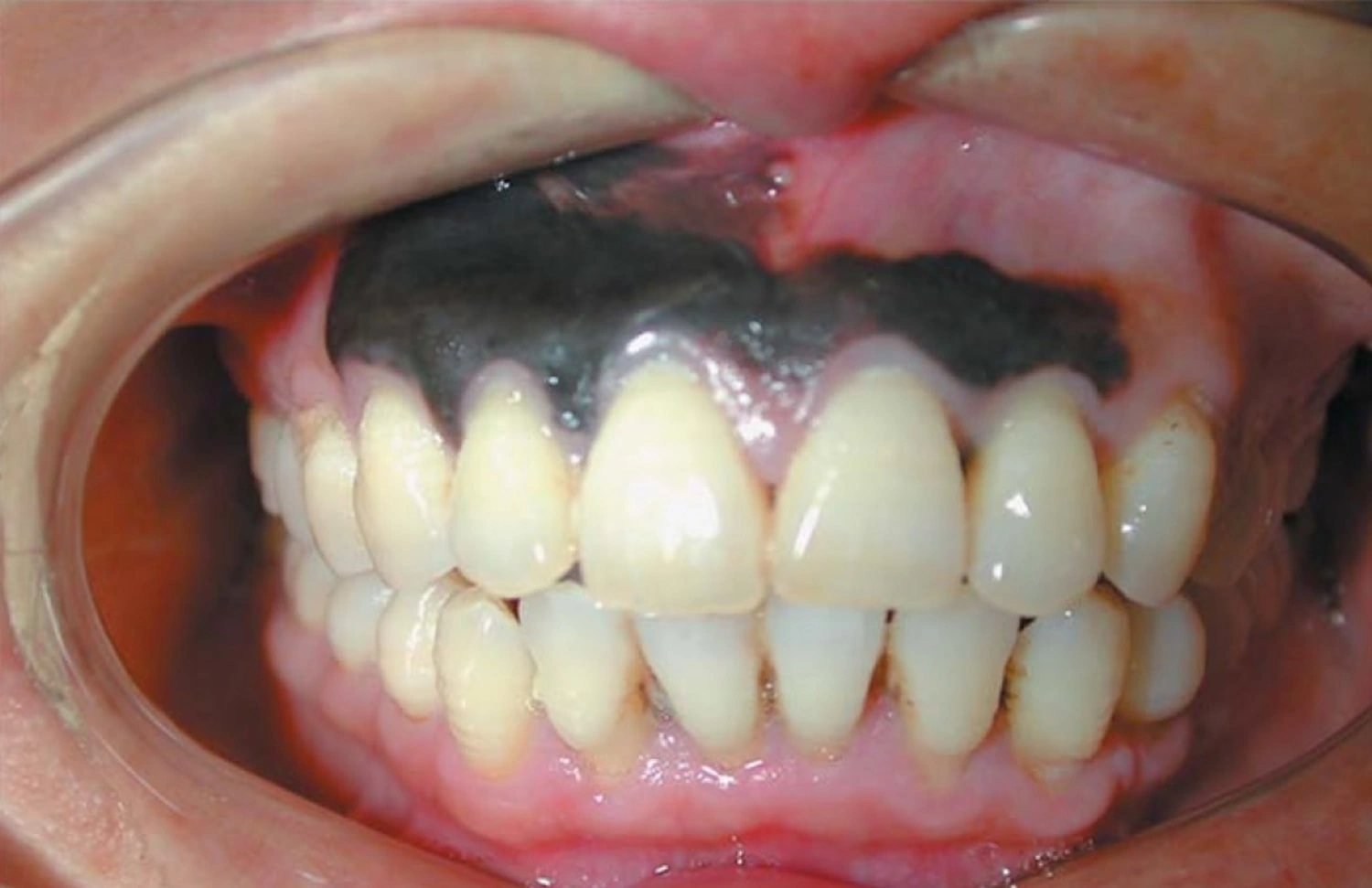 Oral Cancer Black Spot on Gums Photos: What That Dark Dot Could Mean