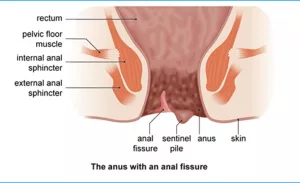 Pain in Anus Hole Home Remedies: Real Relief, Zero Embarrassment