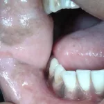 Painless Black Spot Inside Cheek Pictures: Your Friendly Guide