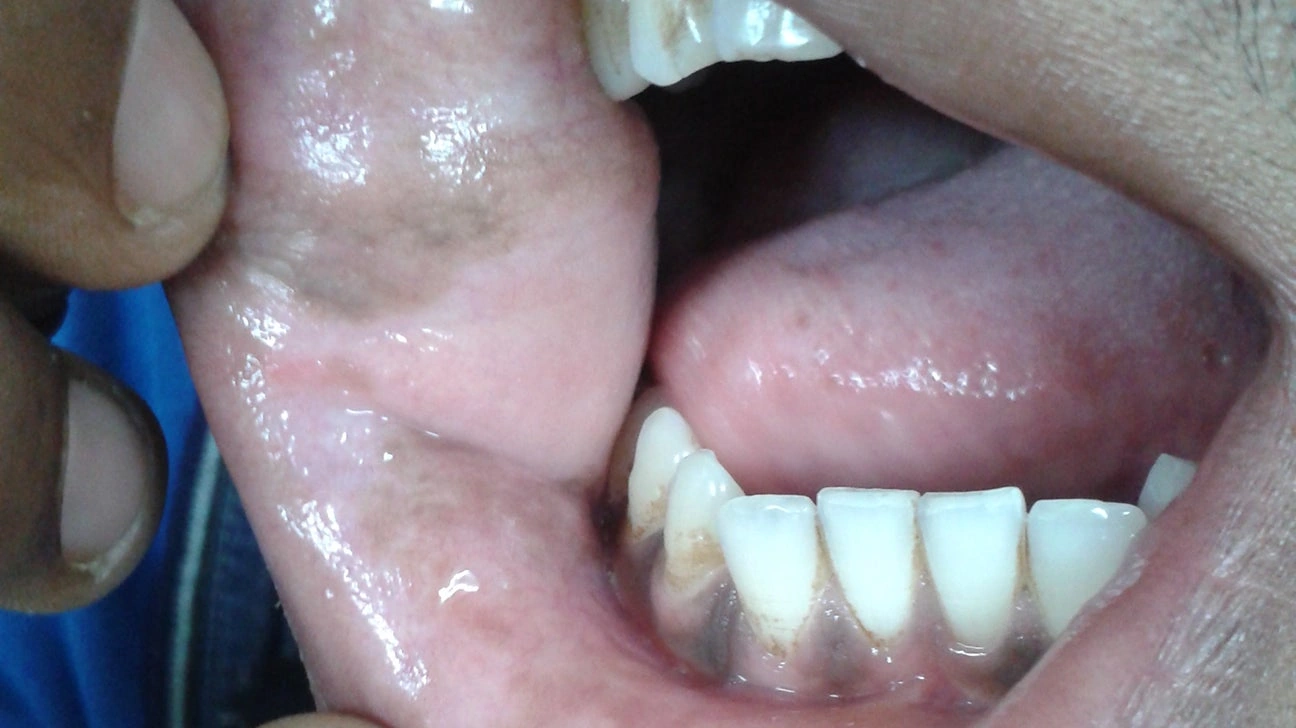 Painless Black Spot Inside Cheek Pictures: Your Friendly Guide