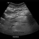 Pancreas Obscured by Bowel Gas Treatment: A Real Talk Guide
