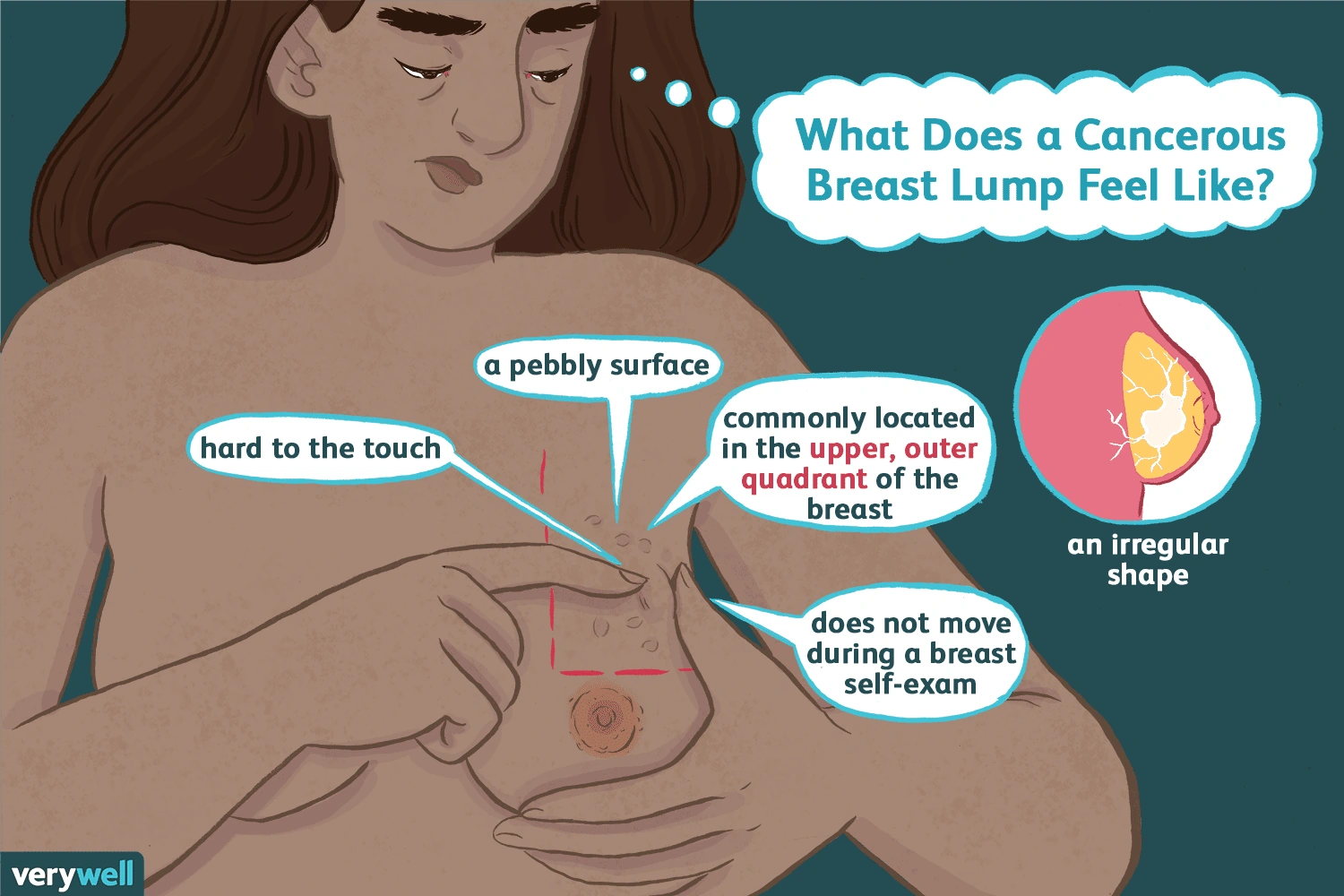 Pictures of Breast Cancer Lumps: What Do They Really Look Like?