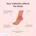 Pictures of Cellulitis: Spot Real Signs