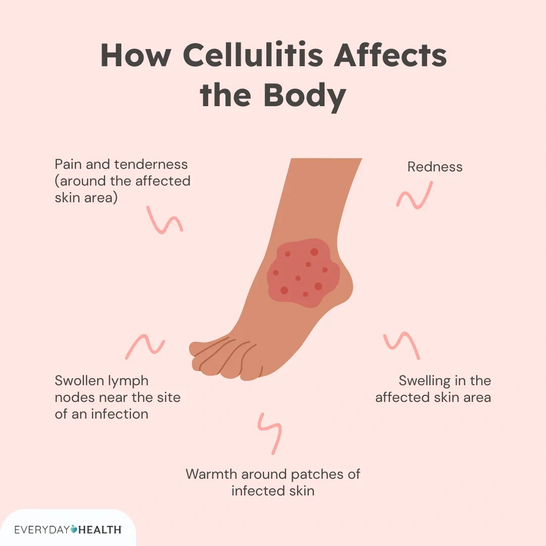 Pictures of Cellulitis: What Real Skin Infection Looks Like