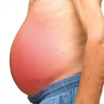 Pictures of Swollen Abdomen Due to Liver Disease