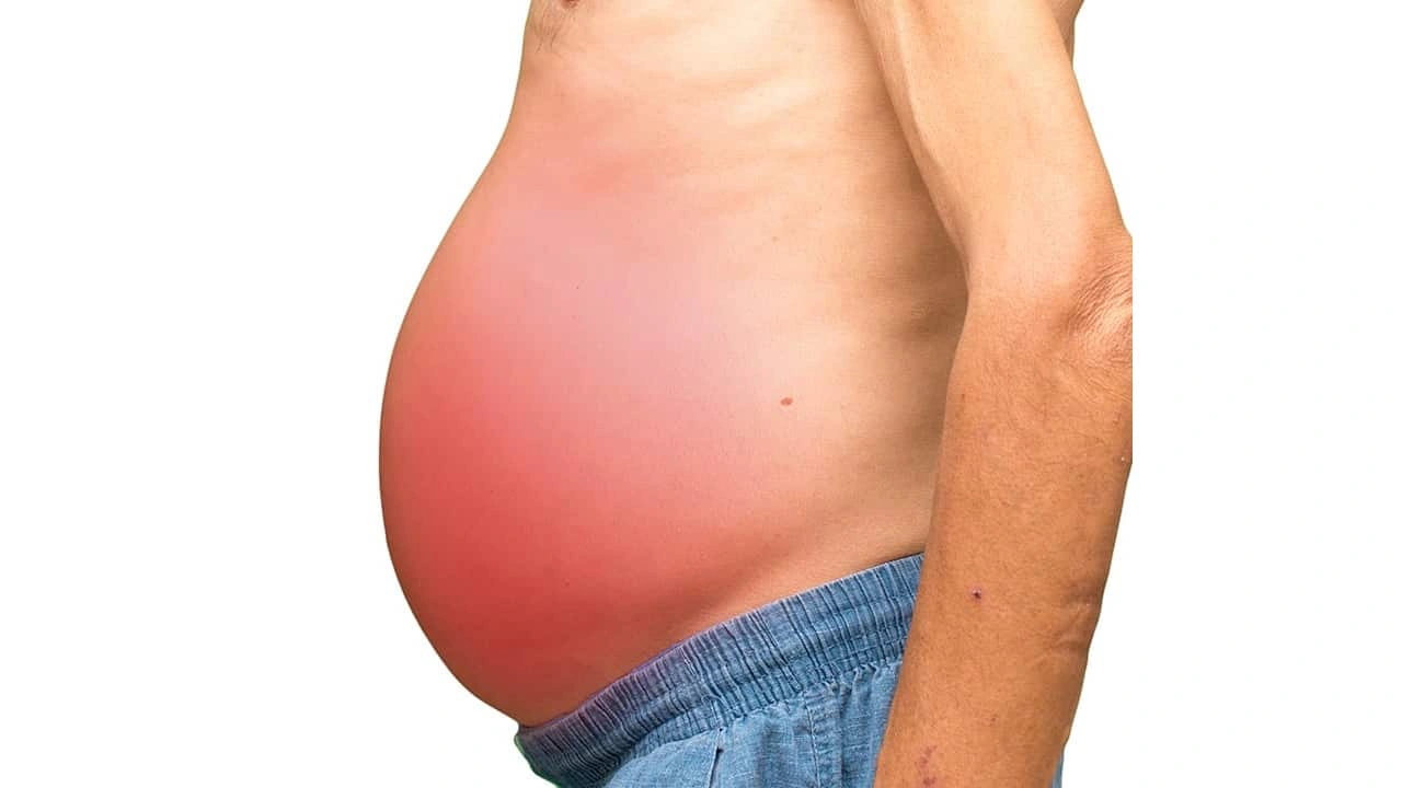 Pictures of Swollen Abdomen Due to Liver Disease: Real Talk About Bloating, Worries, and What to Do