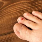 Pinky Toe Blister Treatment: Easy Fixes You’ll Actually Use Pinky Toe Blister Treatment: Easy Fixes You’ll Actually Use