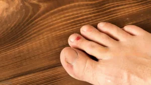 Pinky Toe Blister Treatment: Easy Fixes You’ll Actually Use Pinky Toe Blister Treatment: Easy Fixes You’ll Actually Use