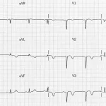 What is Poor R Wave Progression?