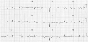 Poor R Wave Progression: What Your Heart’s Really Telling You Poor R Wave Progression: What Your Heart’s Really Telling You