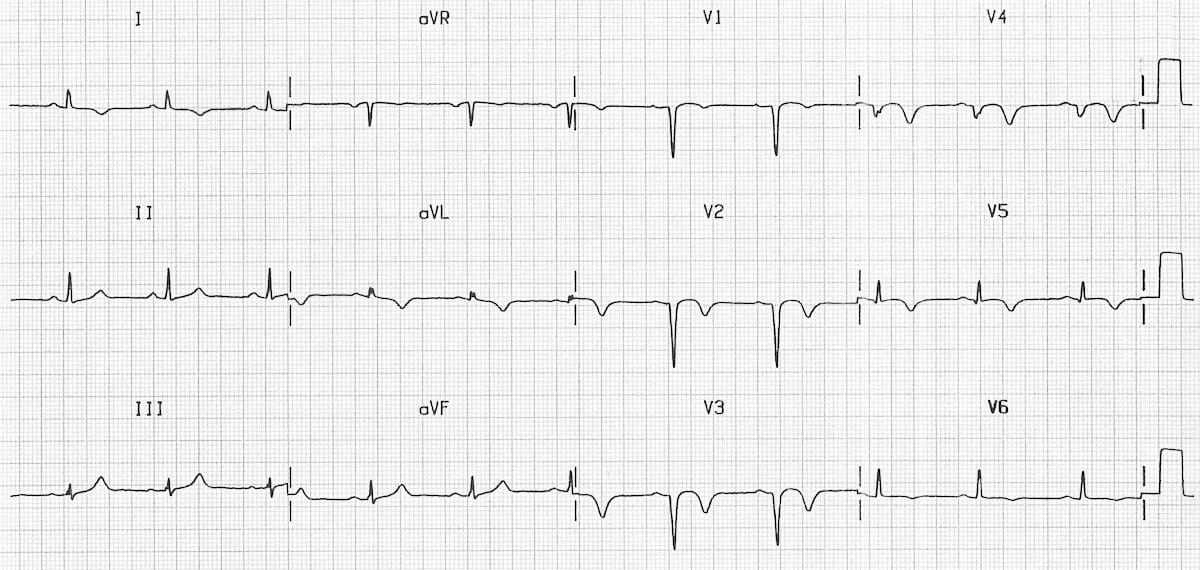 Poor R Wave Progression: What Your Heart’s Really Telling You
