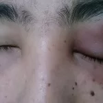 Preseptal Cellulitis ICD 10: Real Talk on That Scary Eyelid Swelling