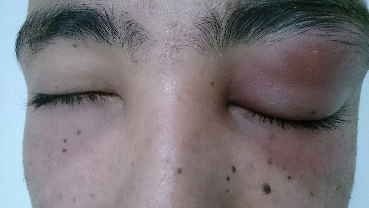 Preseptal Cellulitis ICD 10: Real Talk on That Scary Eyelid Swelling