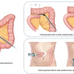 Quality of Life After Right Hemicolectomy Guide