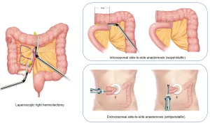 Quality of Life After Right Hemicolectomy: Honest Talk, Real Recovery Quality of Life After Right Hemicolectomy: Honest Talk, Real Recovery