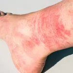 Red Rash on Lower Legs Above Ankles Pictures: What’s Really Going On?
