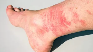 Red Rash on Lower Legs Above Ankles Pictures: What’s Really Going On?
