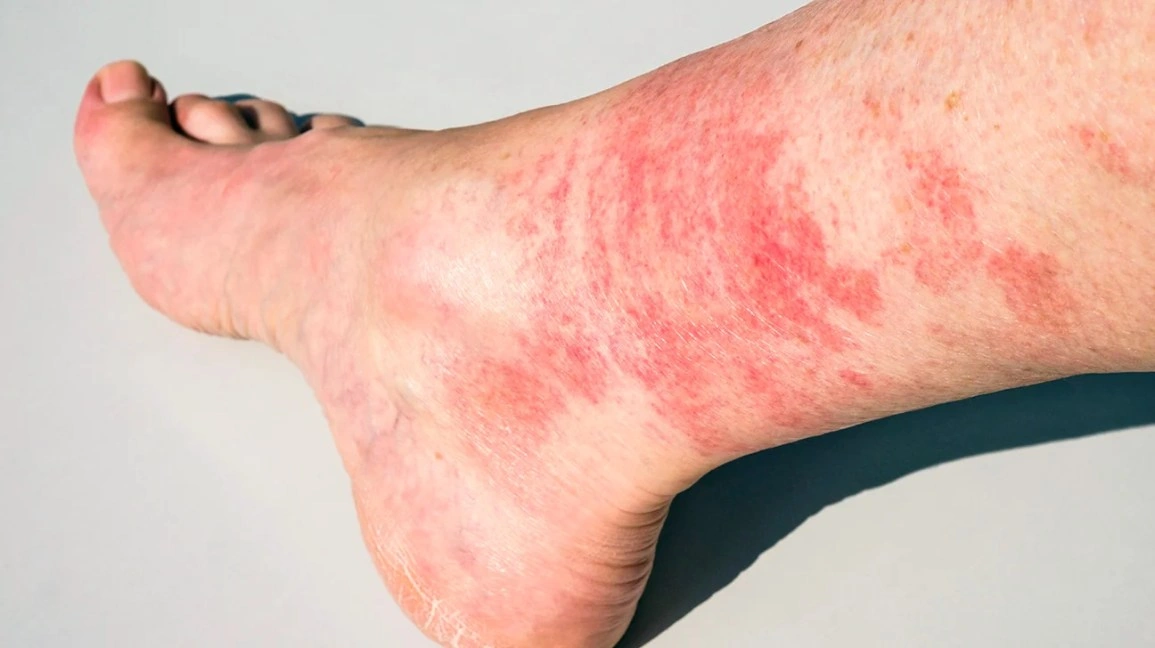 Red Rash on Lower Legs Above Ankles Pictures: What’s Really Going On?