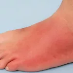 Red Soles of Feet Symptoms: What Your Soles Are Telling You Red Soles of Feet Symptoms: What Your Soles Are Telling You