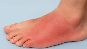 Red Soles of Feet Symptoms: What Your Soles Are Telling You