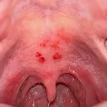 Red Spots on Roof of Mouth: Causes & Tips