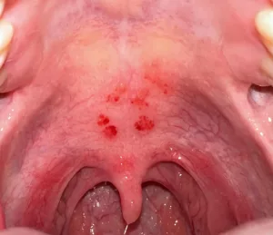 Red Spots on Roof of Mouth? Here’s What No One Tells You