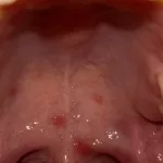 Red Spots on Roof of Mouth Pictures Guide