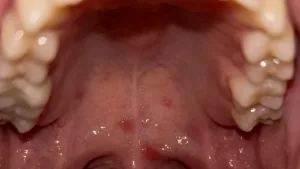 Red Spots on Roof of Mouth Pictures: What’s Really Going On?