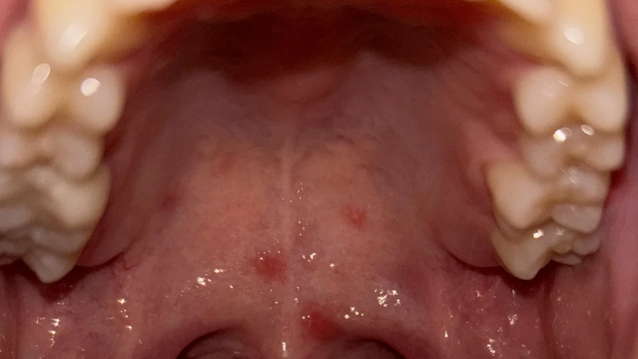 Red Spots on Roof of Mouth Pictures: What’s Really Going On?
