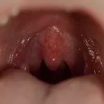 Red Spots Roof of Mouth in Child Causes