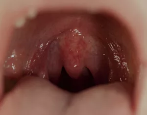 Red Spots Roof of Mouth Child: What to Know and What to Do