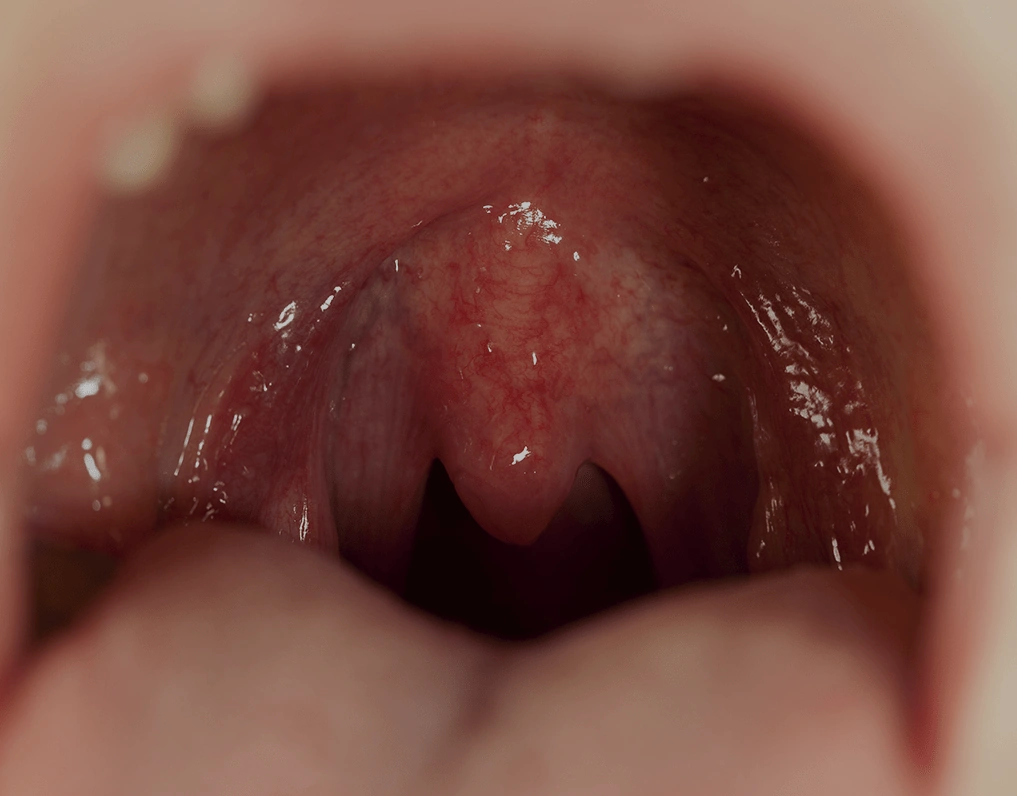 Red Spots Roof of Mouth Child: What to Know and What to Do