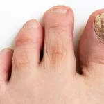 Stages of Toenail Growing Back After Fungus