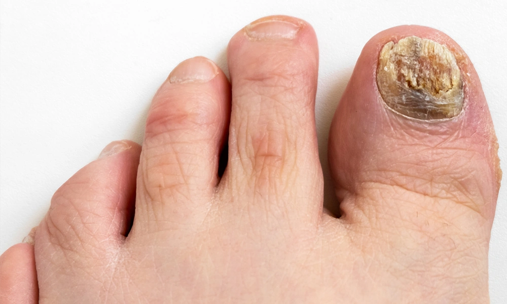 Stages of Toenail Growing Back After Fungus: A Real-Life Recovery Guide