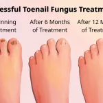 See Stages of Toenail Growing Back Pictures