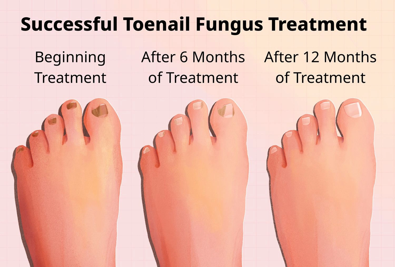 Stages of Toenail Growing Back Pictures: Your Nail’s Comeback Story