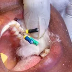 Symptoms of Nerve Damage After Dental Injection