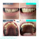 Teeth Straightening Kit At-Home Guide