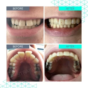 Level Up Your Smile: The Real Story on Teeth Straightening Kit At-Home Level Up Your Smile: The Real Story on Teeth Straightening Kit At-Home