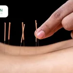 Top 10 Benefits of Acupuncture Guide