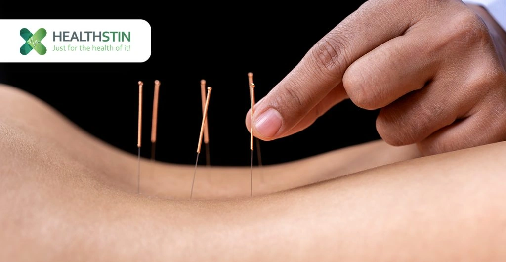 Top 10 Benefits of Acupuncture Everyone Talks About