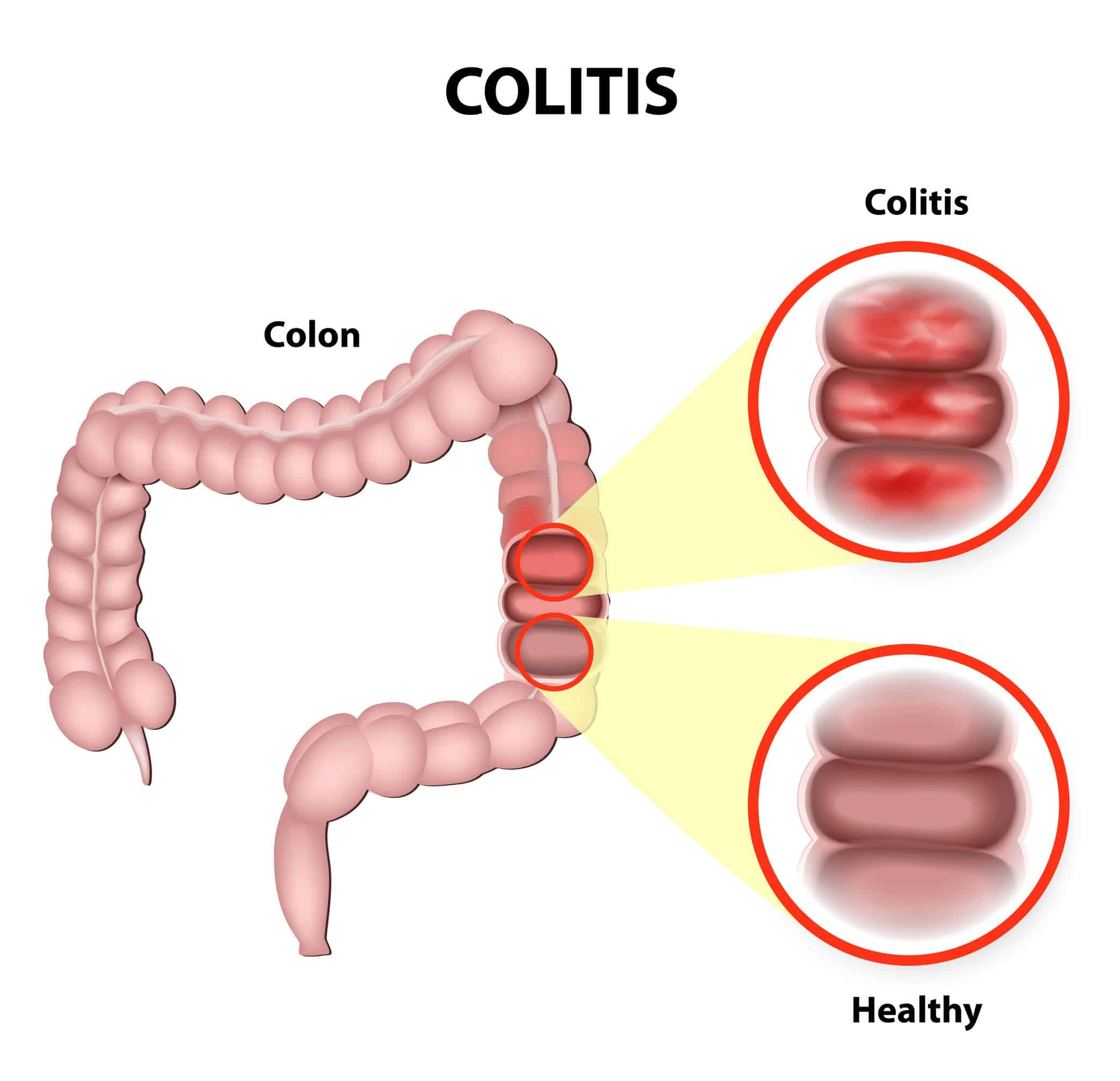 Vedolizumab Side Effects: What to Expect On Your Gut Healing Journey
