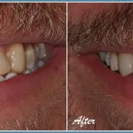 Veneers Cost Per Tooth in California