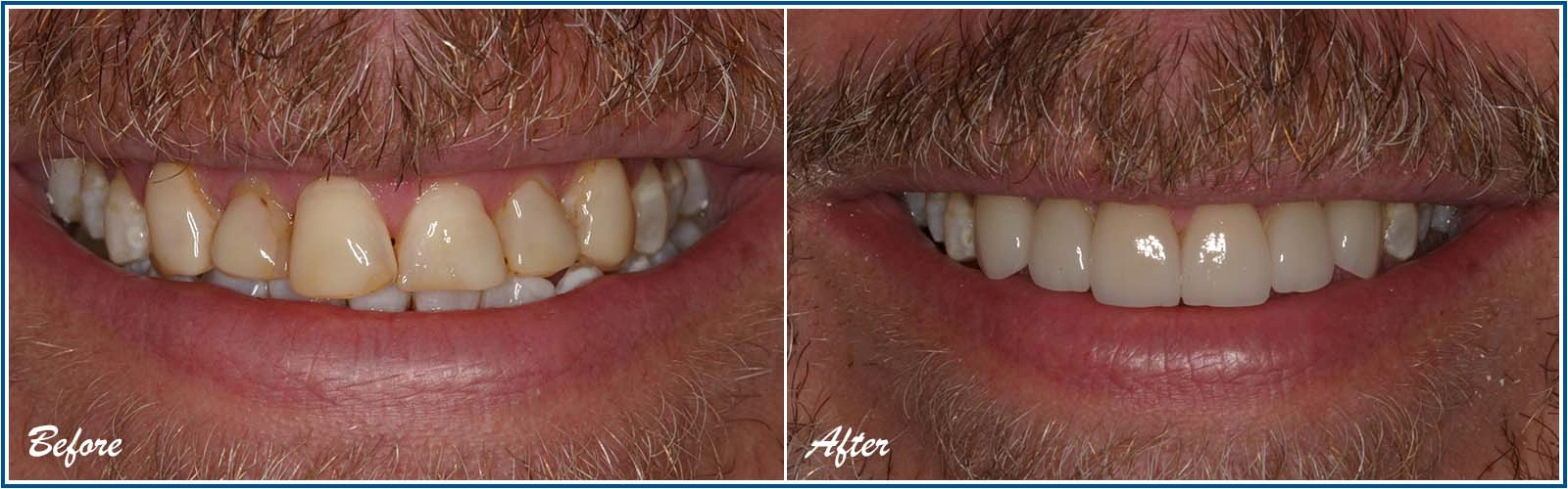 Veneers Cost Per Tooth in California: What Really Impacts Your Smile Investment?
