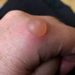 Water Blisters on Legs Pictures Guide